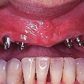 Implantate eingesetzt mit Durchtrittspfosten zur Aufnahme der Brücke.