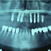 Röntgenaufnahme eingesetzte Implantate mit aufgebrachten Durchtrittspfosten.