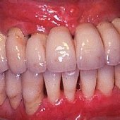 Die fertige festsitzende Versorgung mit Keramikbrücke.