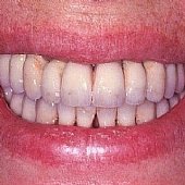 Die Lachinie der fertigen festsitzenden Versorgung mit Keramikbrücke.