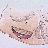 Darstellung der Fensterung der seitlichen Kieferhöhlenwand als Zugang zum Aufbau des Kieferknochens.