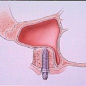 Frontalansicht eines Kieferhöhlenaufbaus (Sinuslift) mit Knochenersatzgewebe.