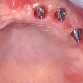 Oberkieferversorgung mit Implantaten nach Sinuslift.