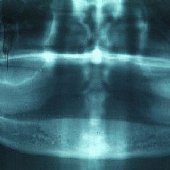 Röntgenaufnahme des zahnlosen Unterkiefers.