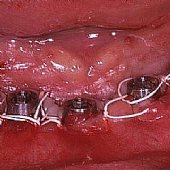 Versorgung mit 5 Implantaten zur Aufnahme der festsitzenden Unterkieferbrücke.