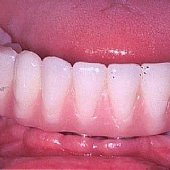 Die fertige fest sitzende Brücke im Unterkiefer.