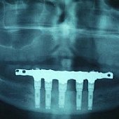 Röntgendarstellung einer fest sitzenden Unterkieferbrücke mit 5 Implantaten.