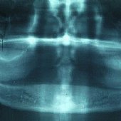 Röntgenaufnahme des zahnlosen Unterkiefers.