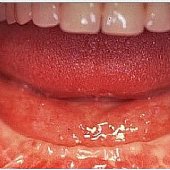 Darstellung des Kieferkammes eines zahnlosen Unterkiefers.