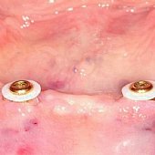 Einbau von 2 Implantaten mit Druckknöpfen zur  Verbesserung des Halte seiner Totalprothese.