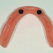 Eingebaute Halteelemente in eine bestehende alte Prothese.