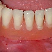 Eingegliederte Totalprothese.