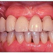 Provisorische Versorgung des Oberkiefers nach Extraktion in einem Seitenzahnbereich. Deutlich ist der Weichgewebs-Effekt zu den Zähnen im Seitenzahnbereich zu erkennen.