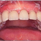 Provisorische Versorgung des Oberkiefers nach Zahnfleisch-Transplantation. Die Defekte sind verschwunden und ausgeglichen.