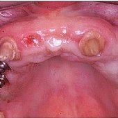 Geschliffene Zähne in Kombination mit Implantaten.
