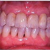 Die fertige Versorgung - mit stark individualisierten Zähnen kann man ein möglichst natürliches Ergebnis erzielen.