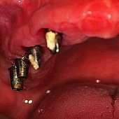 Eingebrachte Implantate mit Durchtrittspfosten zur Aufnahme einer festsitzenden Keramikbrücke.