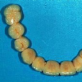 Fertige Vollkeramikbrücke.