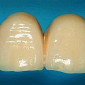 Detailansicht der fertigen Vollkeramikbrücke.