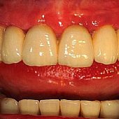 Die eingegliederte Vollkeramikbrücke.