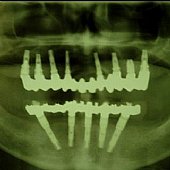 Röntgendarstellung der implantatgetragenen Vollkeramikbrücke im Oberkiefer und klassische Versorgung des zahnlosen Unterkiefers nach der Branemark-Methode.