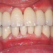 Die fertige Versorgung mit festsitzender Keramikbrücke. Die Zähne sind der Fuß der Patienten weiß und wenig individualisiert.