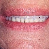 Die Lachlinie der fertigen festsitzenden Versorgung.